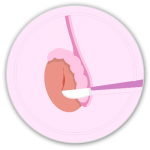 testicular biopsy